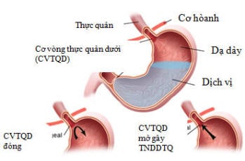 Web thực quản - Ảnh minh họa 1