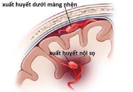 Xuất huyết nội sọ - Ảnh minh họa 2