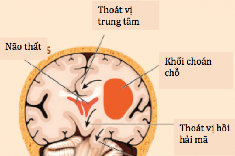 Xuất huyết nội sọ - Ảnh minh họa 1