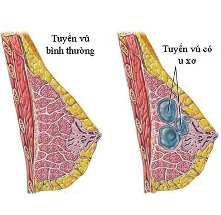 Xơ nang tuyến vú - Ảnh minh họa 2