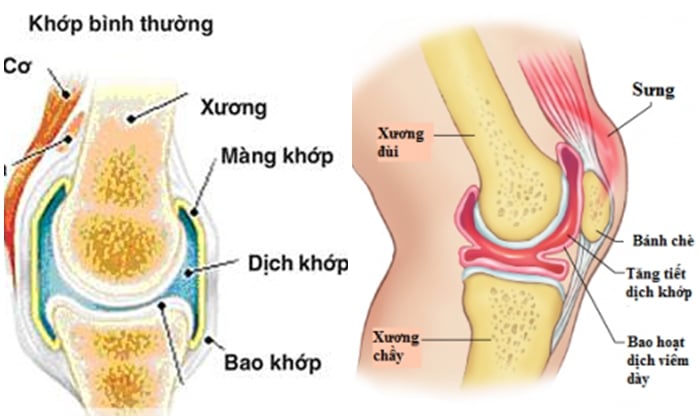 Viêm bao hoạt dịch - Ảnh minh họa 2