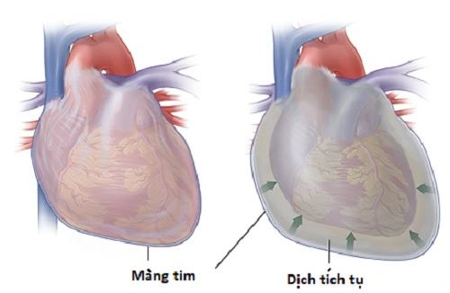 Viêm màng ngoài tim - Ảnh minh họa 3