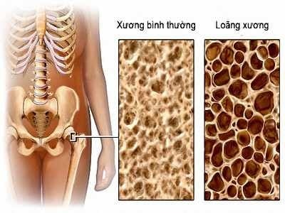 Xốp xương - Ảnh minh họa 2