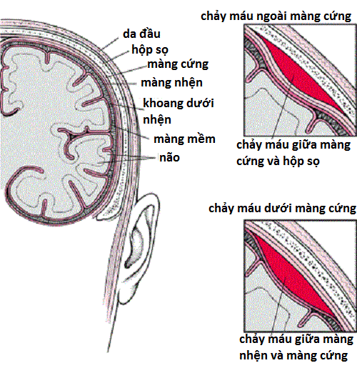 Chảy máu màng não - Ảnh minh họa 2