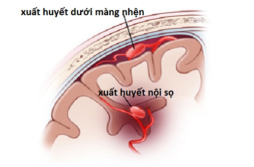 Chảy máu màng não - Ảnh minh họa 1