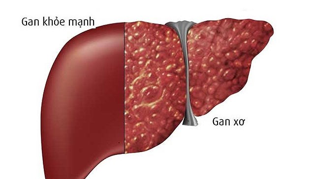 Xơ gan - Ảnh minh họa 1