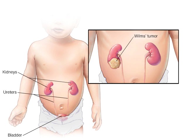 Wilms tumor - Ảnh minh họa 4