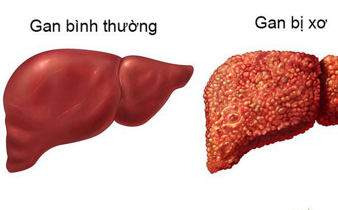 Xơ gan - Ảnh minh họa 3