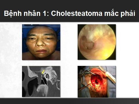 Viêm tai cholesteatoma - Ảnh minh họa 2