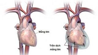 Viêm màng ngoài tim - Ảnh minh họa 4