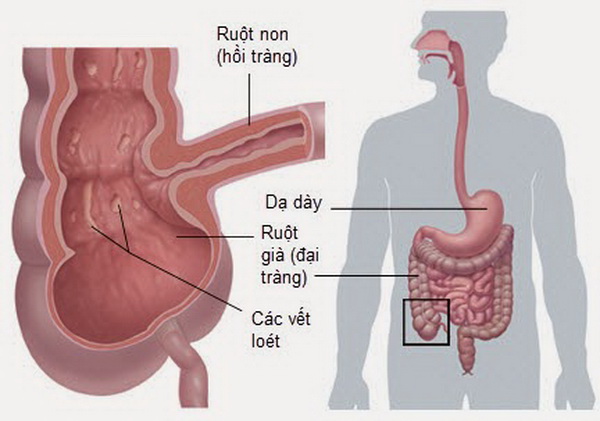 Viêm ruột do vi khuẩn Giardia - Ảnh minh họa 2
