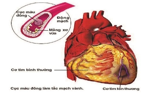 Viêm cơ tim - Ảnh minh họa 3