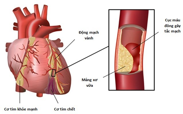 Xơ vữa động mạch - Ảnh minh họa 4