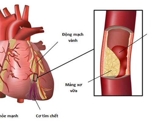 Xơ mỡ động mạch - Ảnh minh họa 4