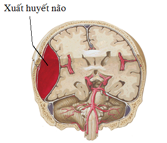 Xuất huyết não - Ảnh minh họa 4