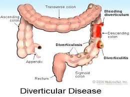 Colon diverticulitis - Ảnh minh họa 2