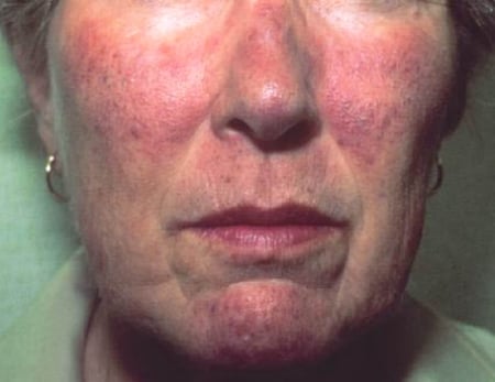 Carcinoid syndrome - Ảnh minh họa 1