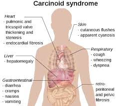 Carcinoid syndrome - Ảnh minh họa 2