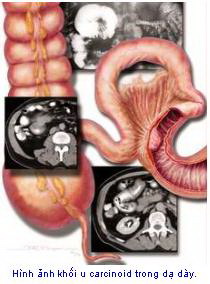 Carcinoid syndrome - Ảnh minh họa 4