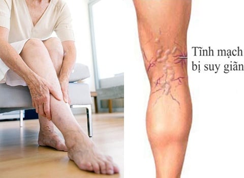 Chronic Venous Insufficiency - Ảnh minh họa 2