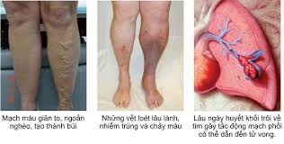 Chronic Venous Insufficiency - Ảnh minh họa 4