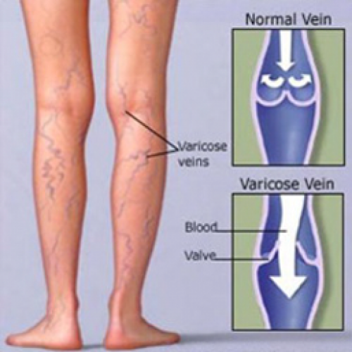 Chronic Venous Insufficiency - Ảnh minh họa 3