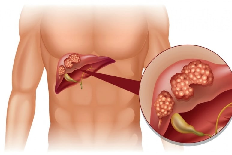 Chronic hepatitis - Ảnh minh họa 3