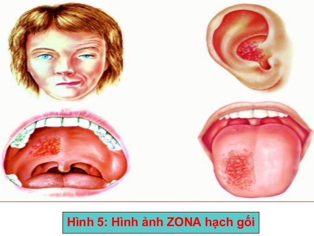 6. Phòng Ngừa Zona Hạch Gối