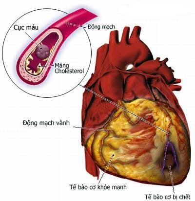 Cơ tim (suy tim) - Ảnh minh họa 2