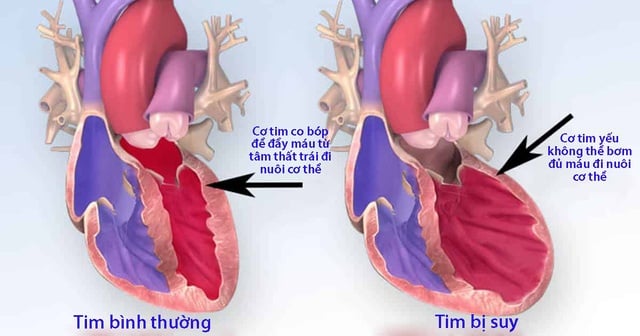 Cơ tim (suy tim) - Ảnh minh họa 3