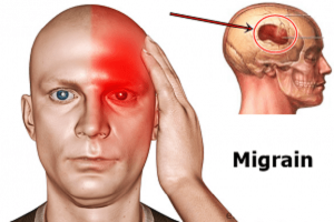 Đau nửa đầu Migraine - Ảnh minh họa 4