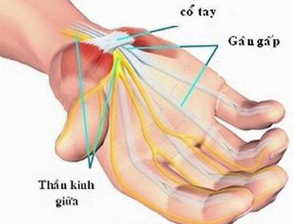 Đứt gân - Ảnh minh họa 2