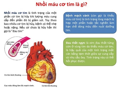 Chứng nhồi máu cơ tim cấp - Ảnh minh họa 2