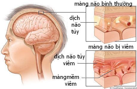 Coccidioidal granuloma - Ảnh minh họa 2