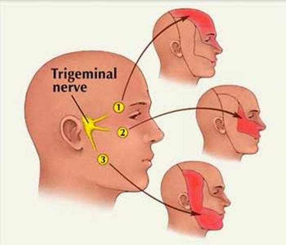 Đau dây thần kinh tam thoa - Ảnh minh họa 2