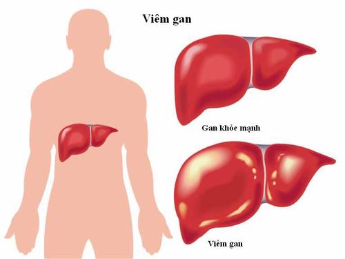 Chấn thương gan - Ảnh minh họa 1