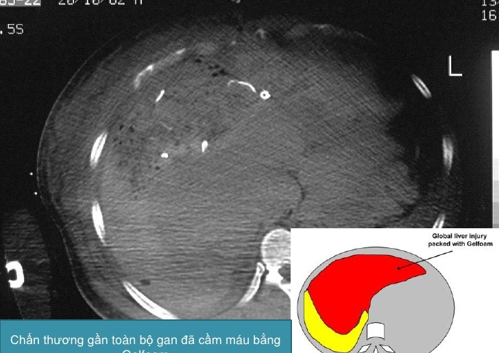 Chấn thương gan - Ảnh minh họa 3