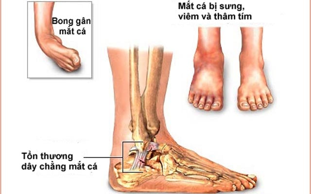 Chấn thương tự phát - Ảnh minh họa 2