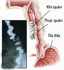 Co thắt thực quản lan tỏa - Ảnh minh họa 2