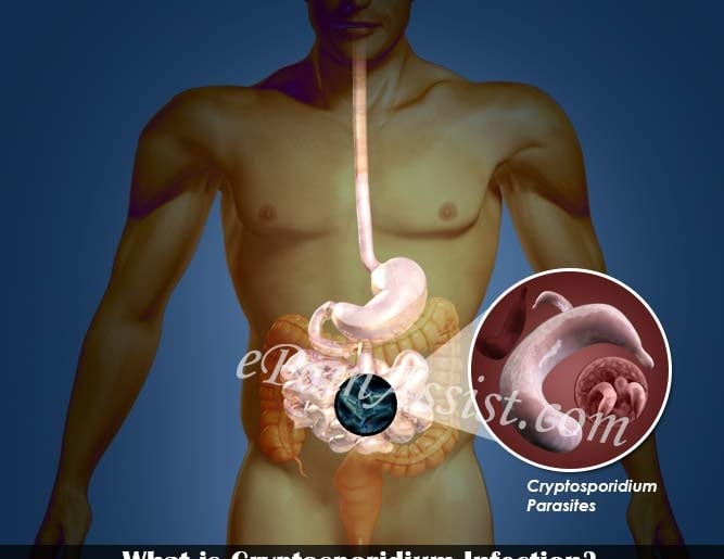 Cryptosporidium infection - Ảnh minh họa 2