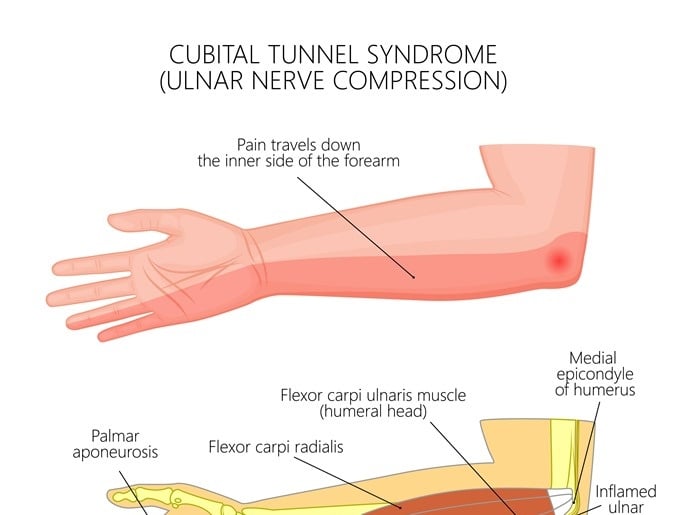 Cubital Tunnel Syndrome - Ảnh minh họa 2