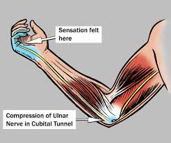 Cubital Tunnel Syndrome - Ảnh minh họa 3