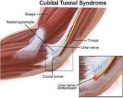 Cubital Tunnel Syndrome - Ảnh minh họa 4