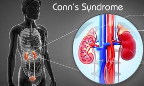 Cường Aldosterone - Ảnh minh họa 3