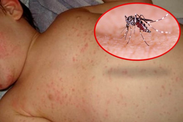 Dengue hemorrhagic fever - Ảnh minh họa 2