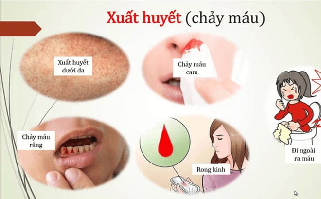 Dengue hemorrhagic fever - Ảnh minh họa 5