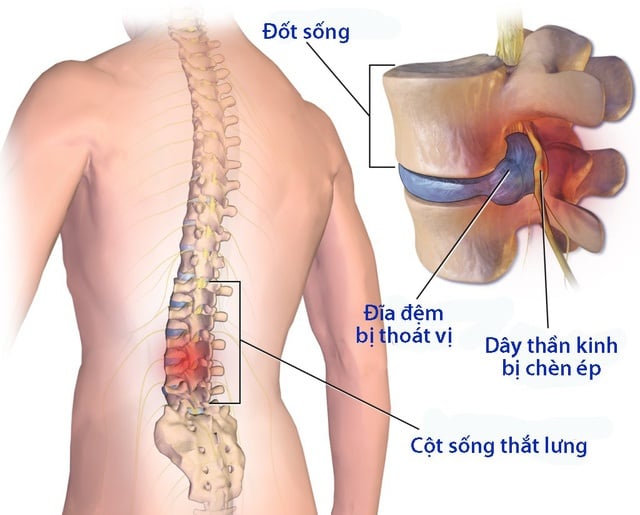 Degenerative Disc Disease - Ảnh minh họa 1