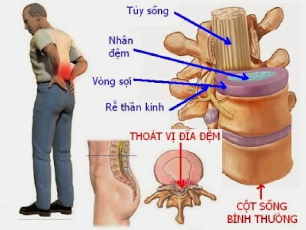 Degenerative Disc Disease - Ảnh minh họa 2