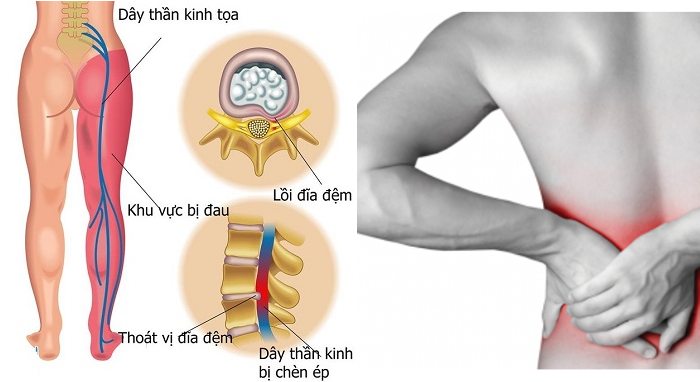 Degenerative Disc Disease - Ảnh minh họa 3