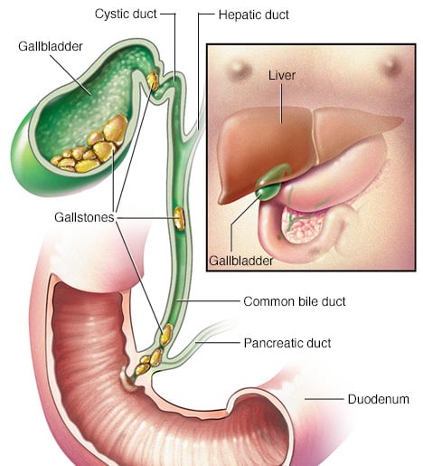 Cholangitis - Ảnh minh họa 2